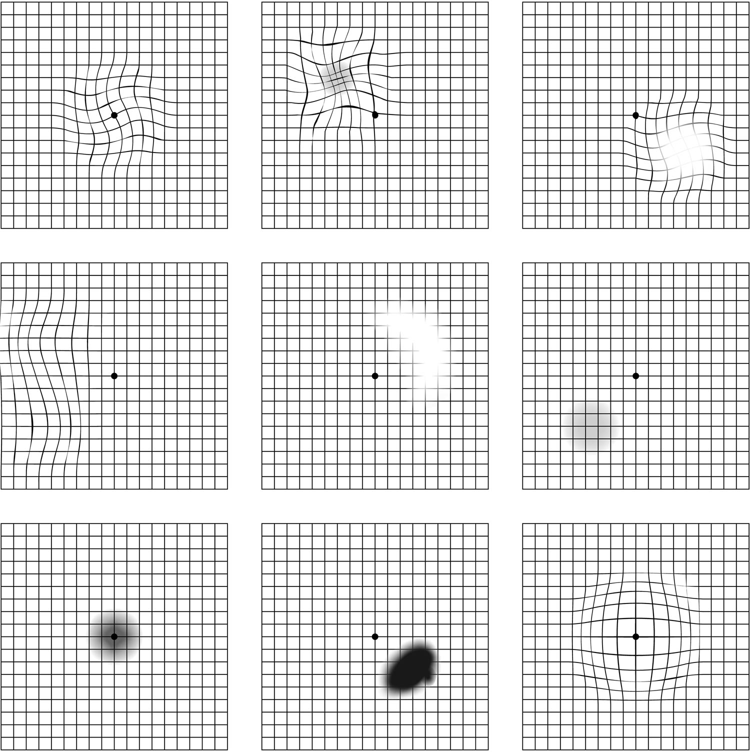 Amsler grid eye test for detecting macular problems